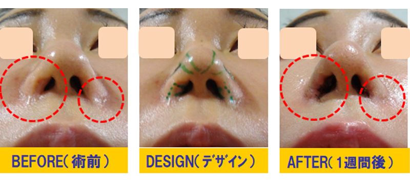 鼻孔過剰狭小化・鼻孔左右差の修正-症例3