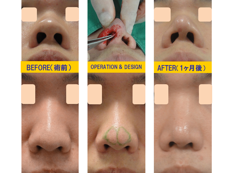 完全クローズ法で鼻孔の形を変える手術-症例3