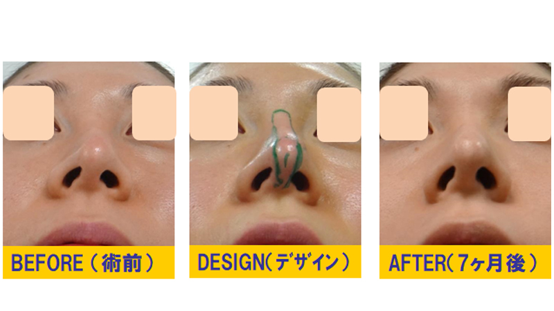 完全クローズ法で傾斜鼻・湾曲鼻・変形鼻の修正