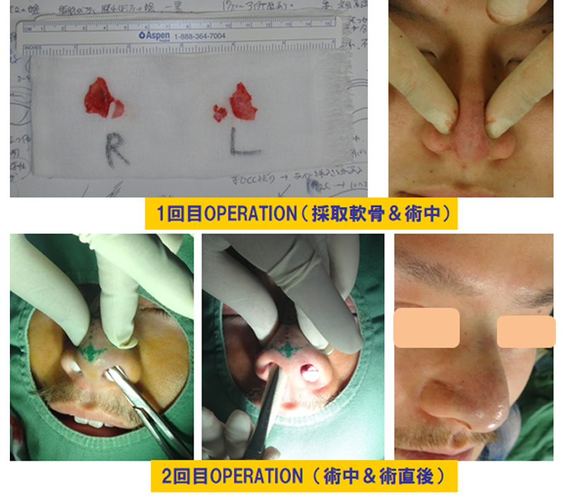 太い鼻の修正-症例1-2
