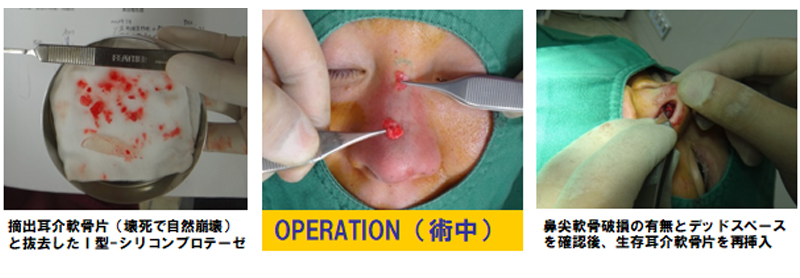 完全クローズ法で傾斜鼻・湾曲鼻・変形鼻の修正-症例1-2