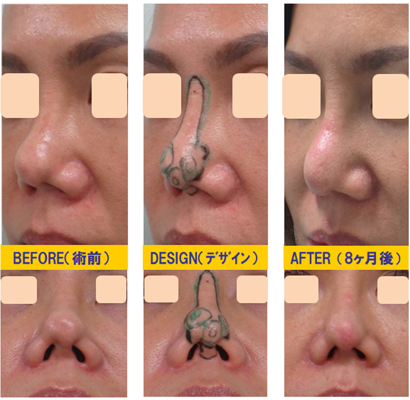 完全クローズ法で傾斜鼻・湾曲鼻・変形鼻の修正-症例3-1