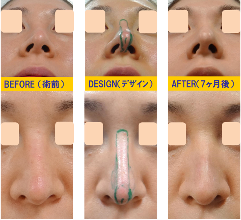 完全クローズ法で傾斜鼻・湾曲鼻・変形鼻の修正-症例1-1