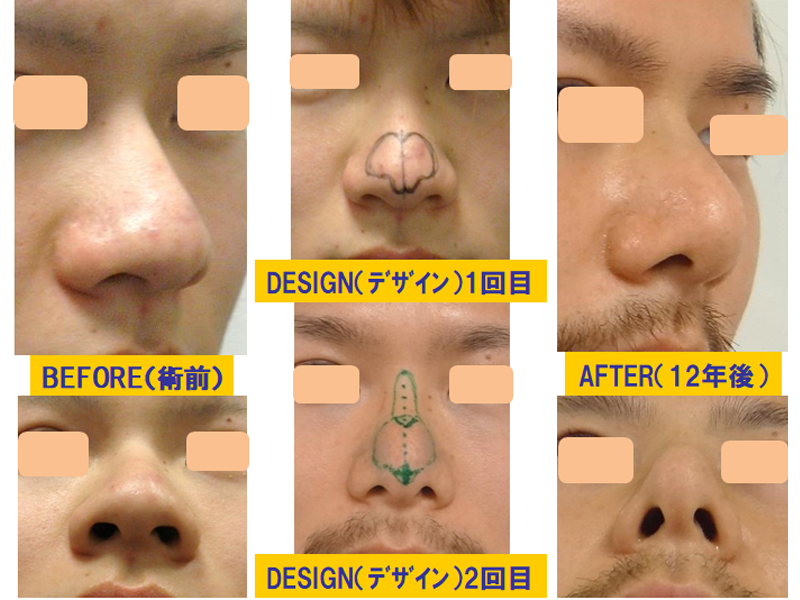 太い鼻の修正-症例1-1