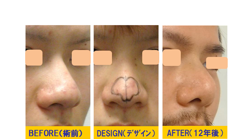 太い鼻の修正