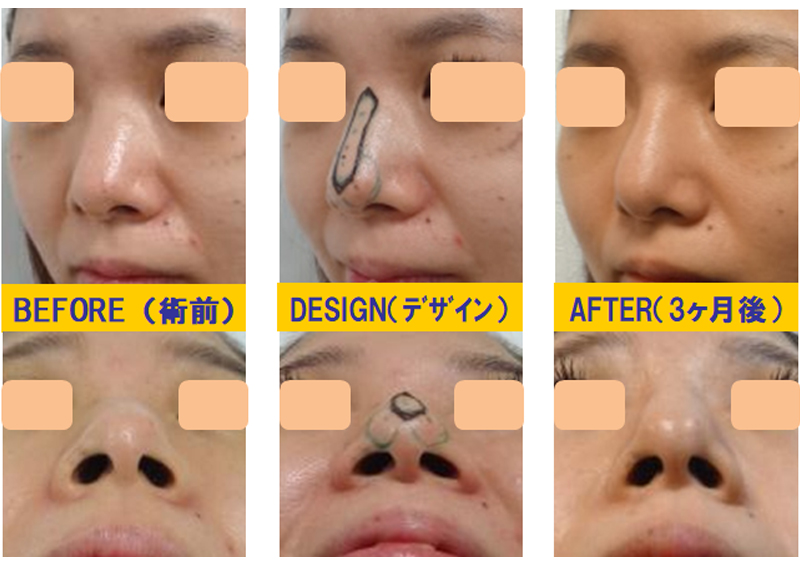 太い鼻の修正-症例2-1