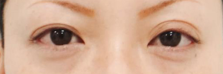 眼瞼の形成の症例画像