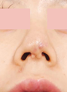 鼻の形成の症例画像